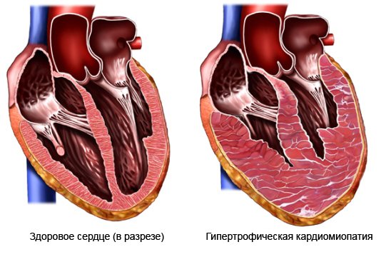 serdce hyp